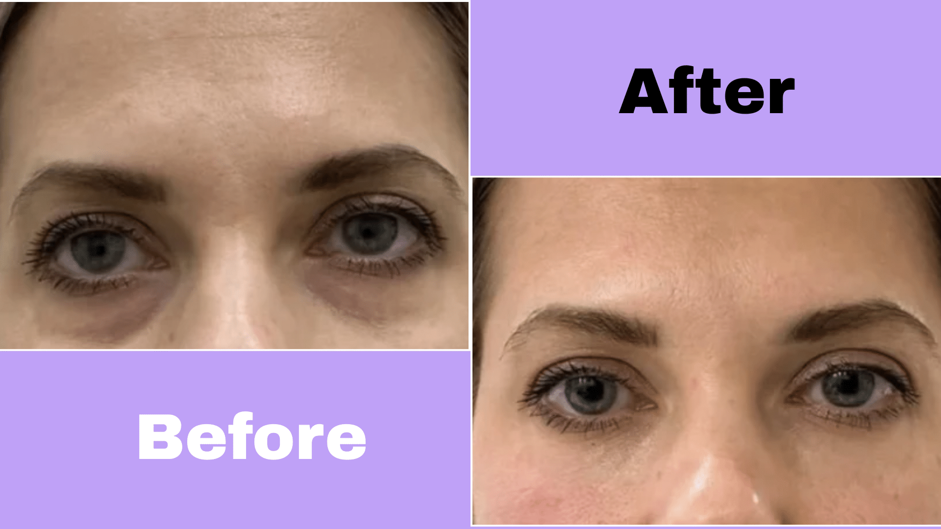 the procedure of prp