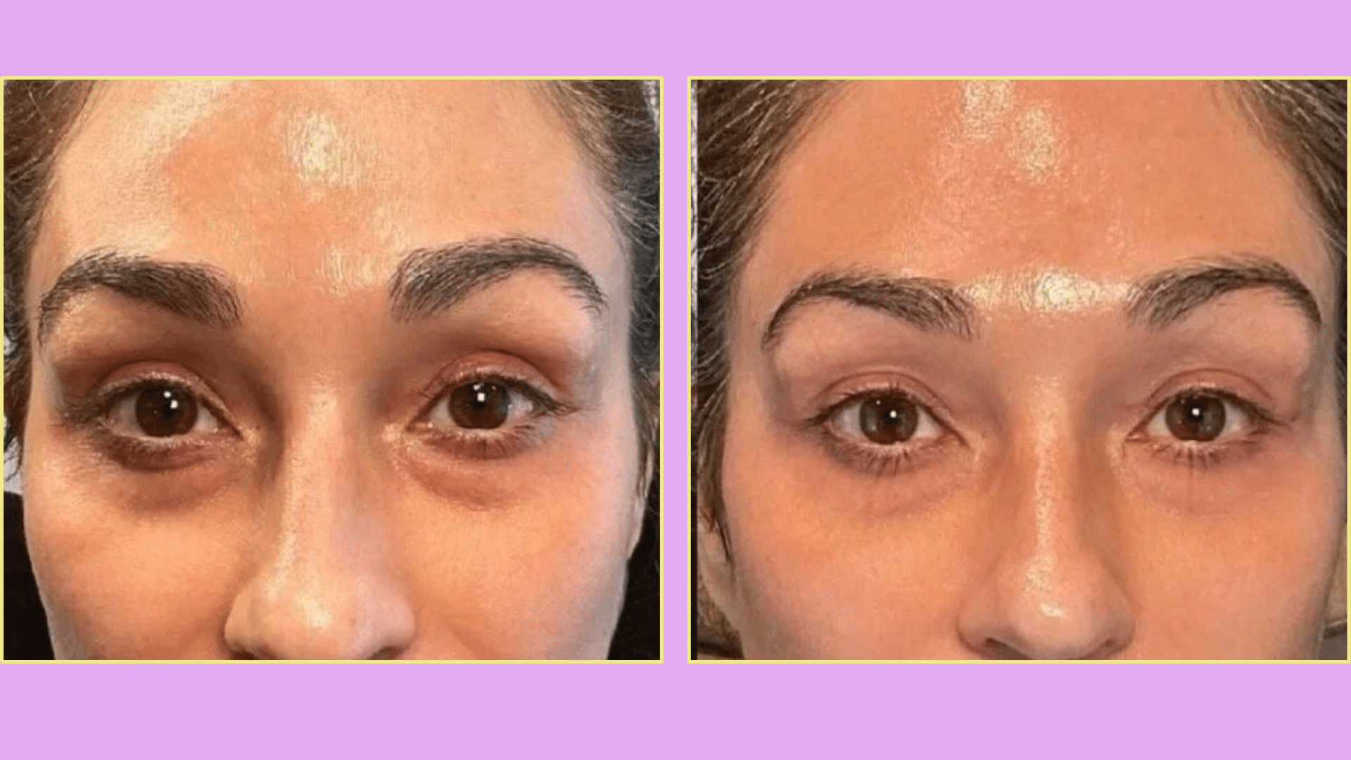 what is prp under eyes its benefits side effects and procedure