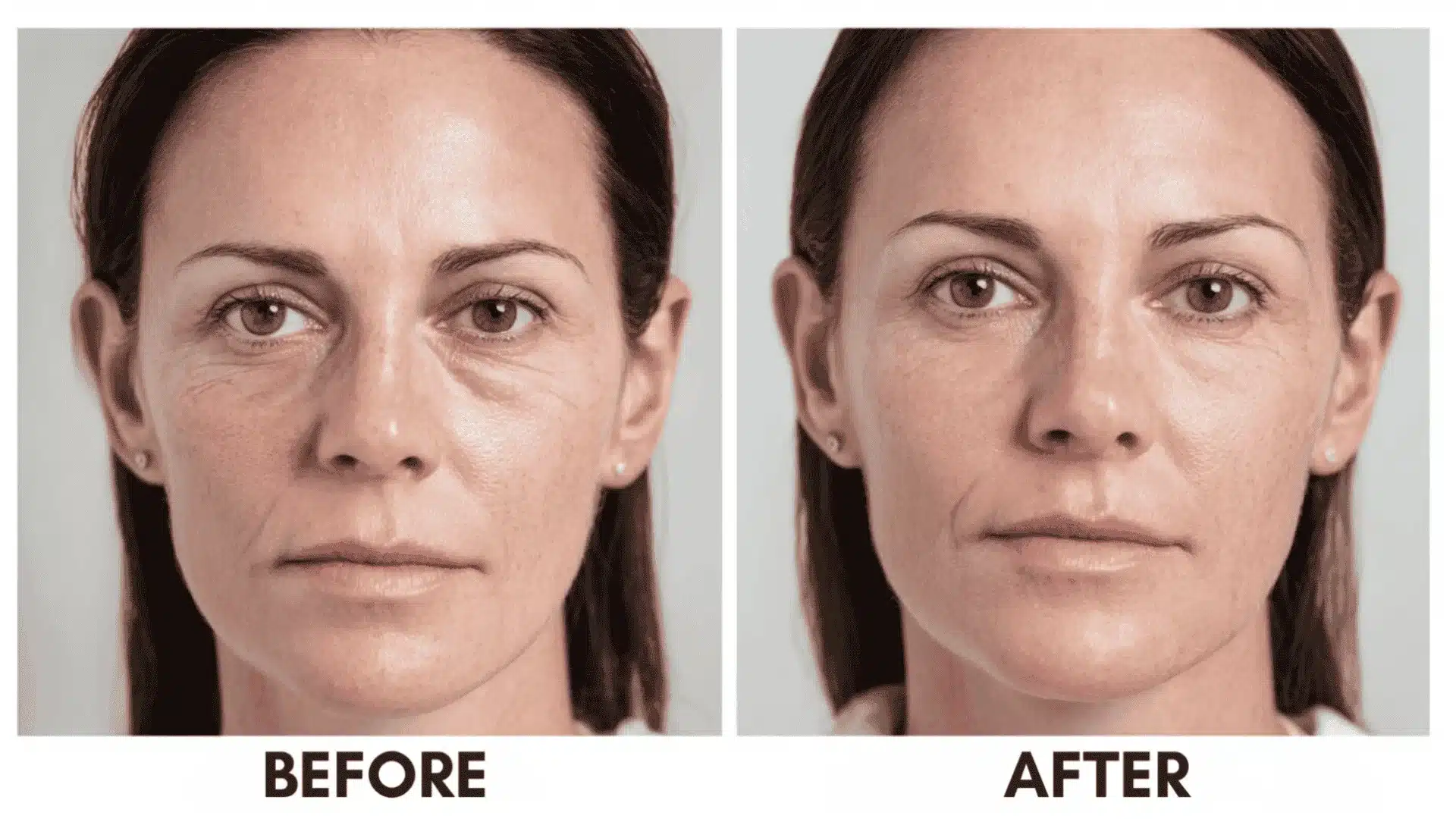 Split view showing a woman face for prp under eyes before and after results with reduced wrinkles and brighter skin tone